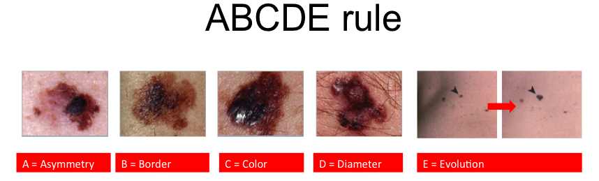 The Skin self-examination ABCDE rule explanation